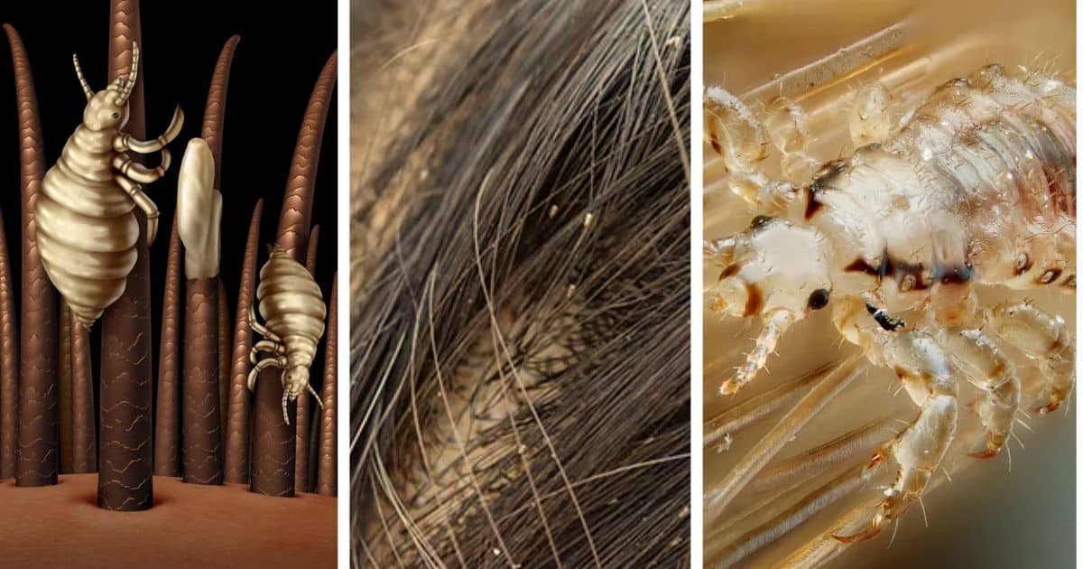 Understanding Head Lice and Nits